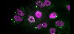 Descubren subtipos con diferente agresividad del c&aacute;ncer de p&aacute;ncreas