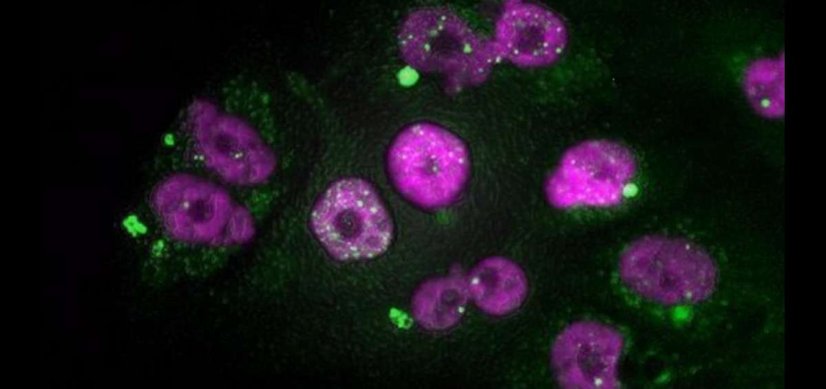 Descubren subtipos con diferente agresividad del c&aacute;ncer de p&aacute;ncreas