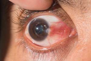 Pterigi&oacute;n: causas, s&iacute;ntomas, prevenci&oacute;n y tratamiento