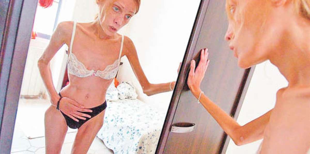 Isabelle Caro, modelo que muri&oacute; por anorexia en 2010, sirvi&oacute; para ilustrar una campa&ntilde;a contra el trastorno. Foto tomada de revue.idnes.cz