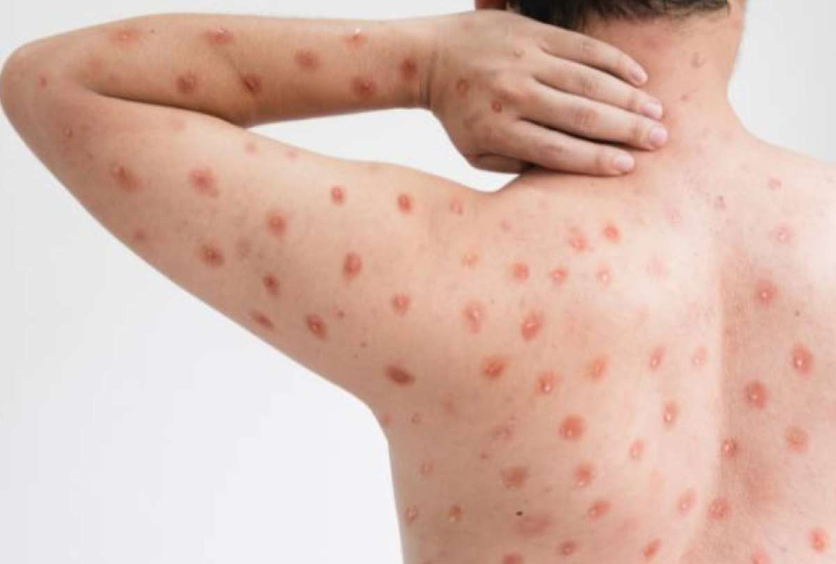 Ministerio de Salud P&uacute;blica confirm&oacute; el primer caso de viruela s&iacute;mica, variante Clado Ib del virus de Mpox.