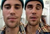 Justin Bieber sufrió parálisis en un lado de su cara