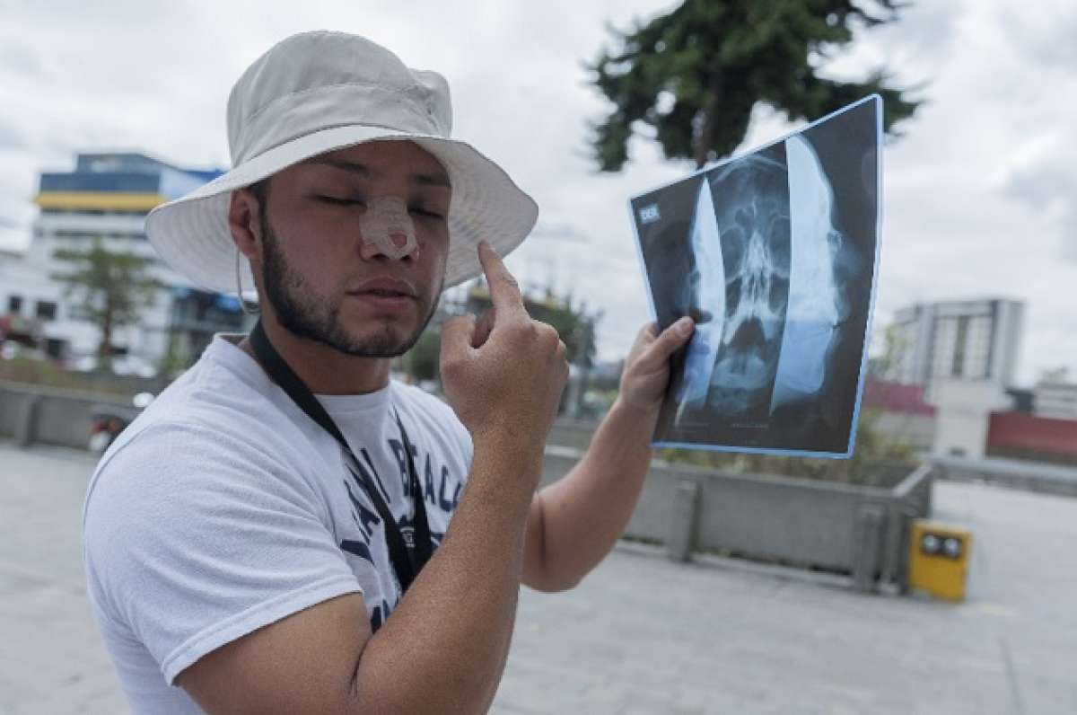 &Aacute;lex M&eacute;ndez muestra las lesiones en su rostro. Foto: Miguel Jim&eacute;nez / El Tel&eacute;grafo 