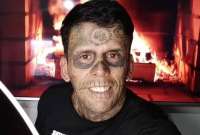Leandro de Souza, el hombre más tatuado de Brasil se quitó los tatuajes de su rostro y cuerpo.