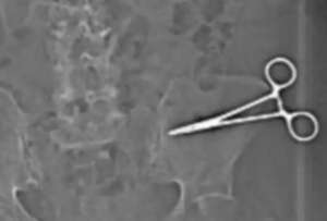 Una mujer convivi&oacute; siete meses con unas tijeras quir&uacute;rgicas dentro de su cuerpo tras una cirug&iacute;a est&eacute;tica en N&aacute;poles.