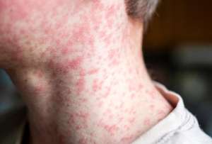 M&eacute;xico registr&oacute; 10.085 casos de sarampi&oacute;n confirmados en esta semana.