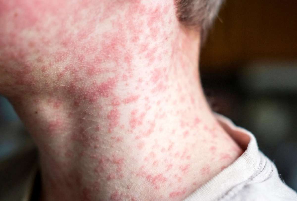 M&eacute;xico registr&oacute; 10.085 casos de sarampi&oacute;n confirmados en esta semana.