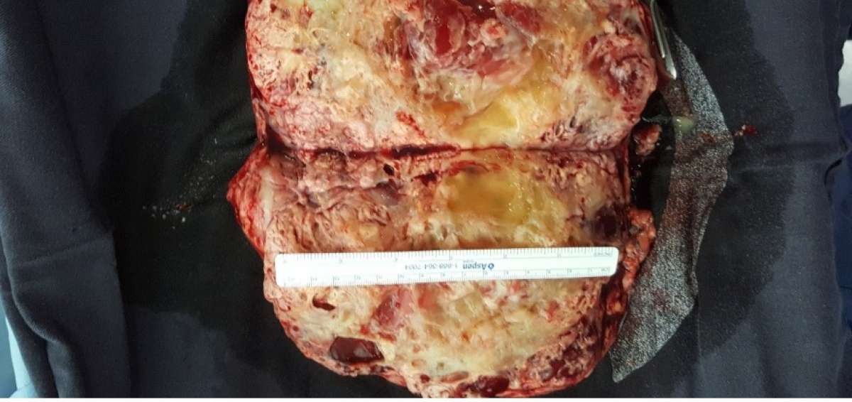 La inmunoterapia demuestra su eficacia en pacientes con c&aacute;ncer renal avanzado
