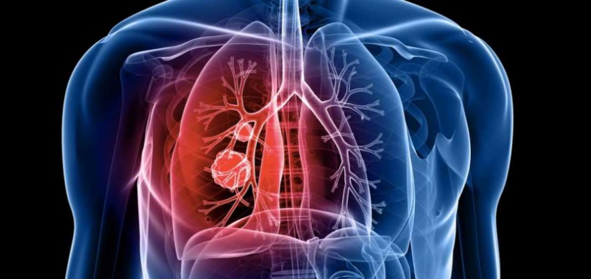 Especialistas brit&aacute;nicos hallan "tal&oacute;n de Aquiles&rdquo; del c&aacute;ncer