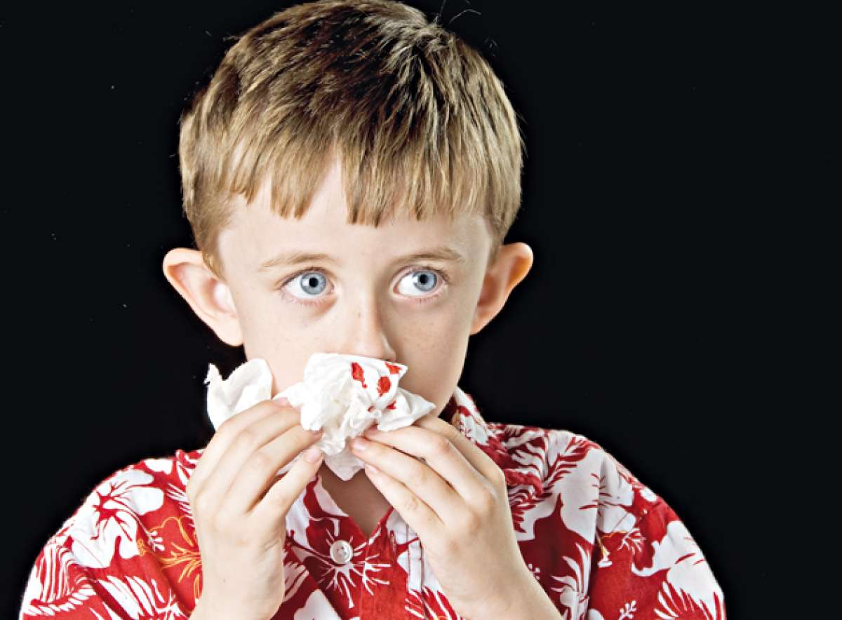 Remedios naturales para detener el sangrado nasal