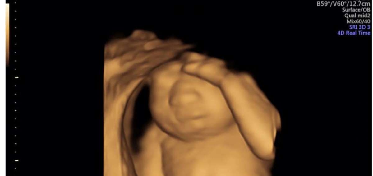Mujer embarazada de beb&eacute; sin cerebro tendr&aacute; a su hija para donar sus &oacute;rganos
