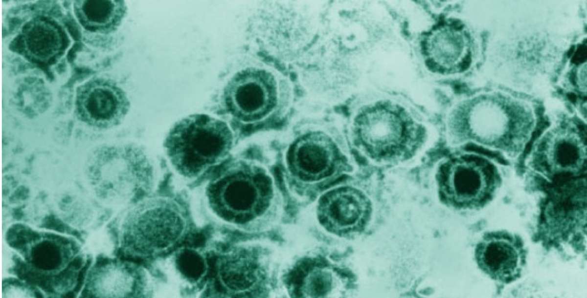 OMS: M&aacute;s del 60% de la poblaci&oacute;n de menos de 50 a&ntilde;os sufre herpes
