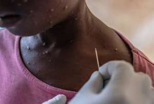 La variante clado 1B ha provocado una emergencia sanitaria en África Central. 