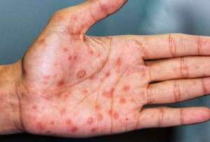 La viruela del mono registra 120 casos en Ecuador. 