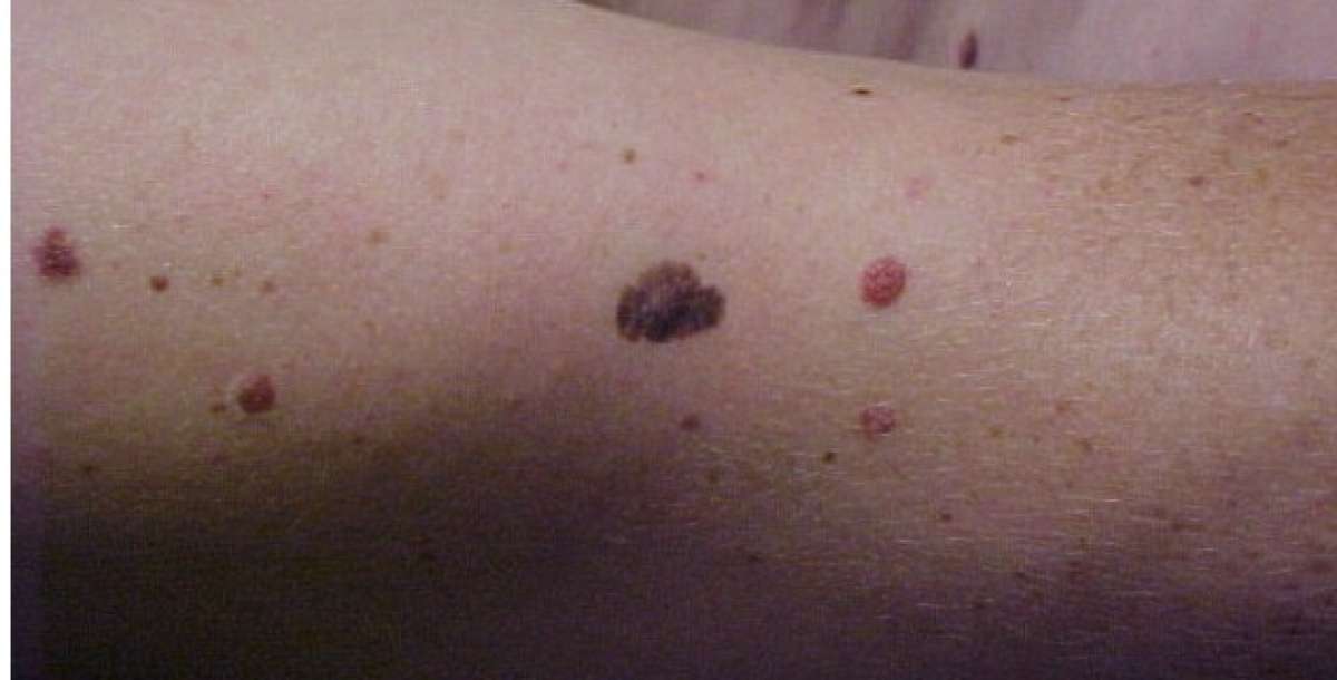 Tener m&aacute;s de 11 lunares en el brazo derecho indica riesgo de melanoma