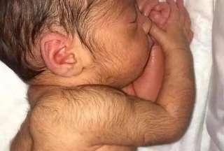 Una investigación en España reveló por qué los bebés nacen con este síndrome. 