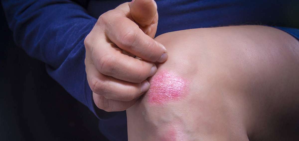 La psoriasis no es contagiosa, pero genera rechazo