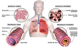 EPOC (enfermedad pulmonar obstructiva cr&oacute;nica)