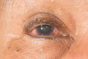¿Quiénes tienen mayor riesgo de desarrollar el glaucoma?