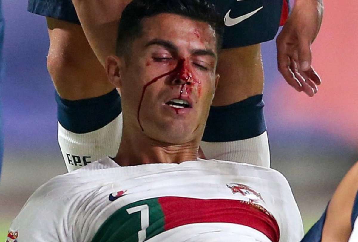 Cristiano Ronaldo casi termina con la nariz rota en el duelo contra República Checa.