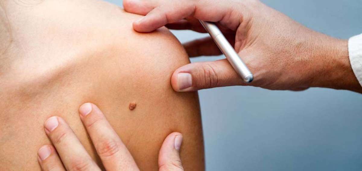 El melanoma es el c&aacute;ncer de piel menos com&uacute;n, pero el m&aacute;s letal