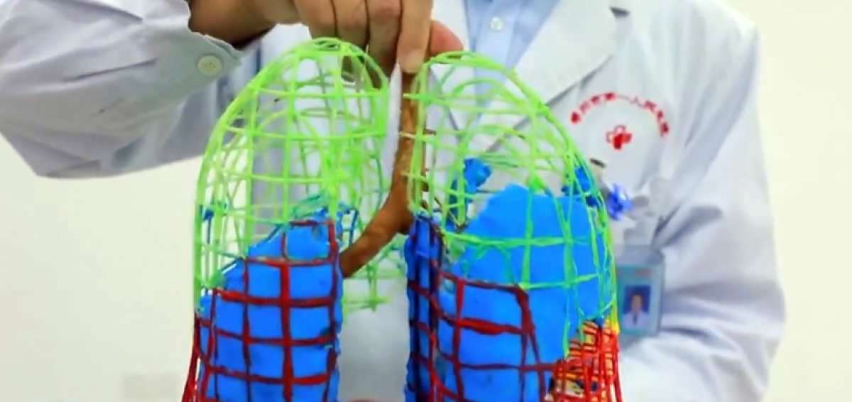 Modelo en 3D de pulmones de un paciente de covid-19.