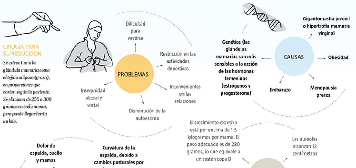 La gigantomastia afecta el estado f&iacute;sico y psicol&oacute;gico de las mujeres