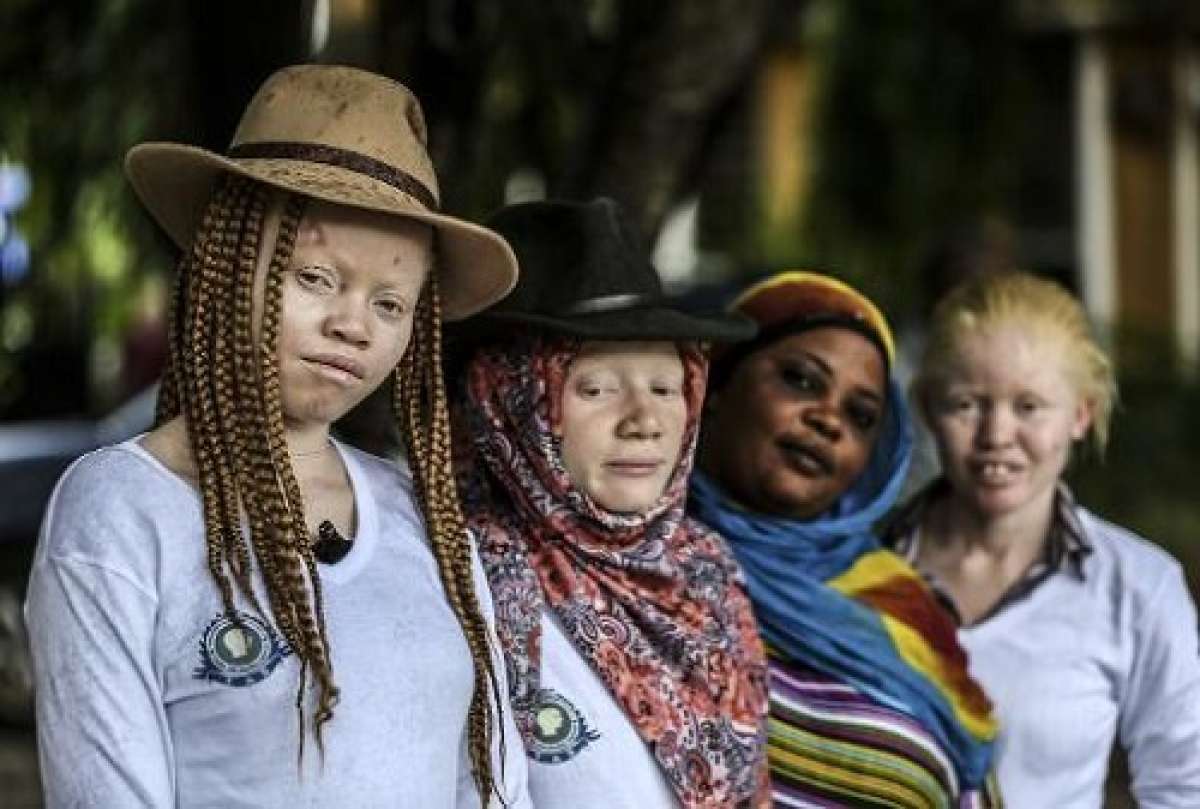 Los albinos en Tanzania son v&iacute;ctimas de la superstici&oacute;n. Foto: Milliyet Daily/AFP