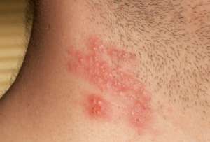 El herpes zóster es causado por el virus de la varicela; presenta quemazón y dolor en la piel