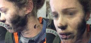 Una mujer sufre quemaduras por la explosi&oacute;n de sus auriculares en un vuelo