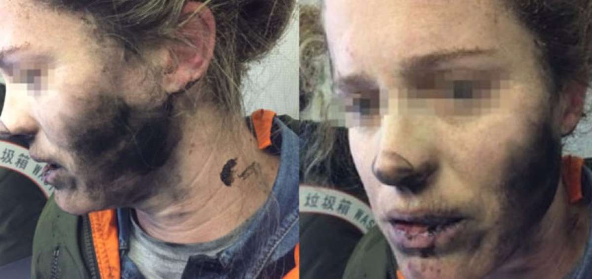 Una mujer sufre quemaduras por la explosi&oacute;n de sus auriculares en un vuelo