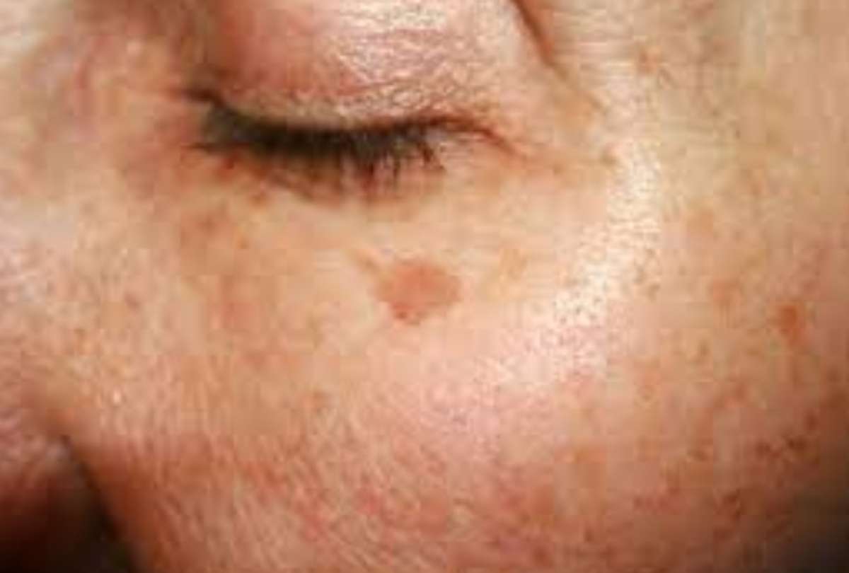 Manchas en la piel: causas y prevenci&oacute;n