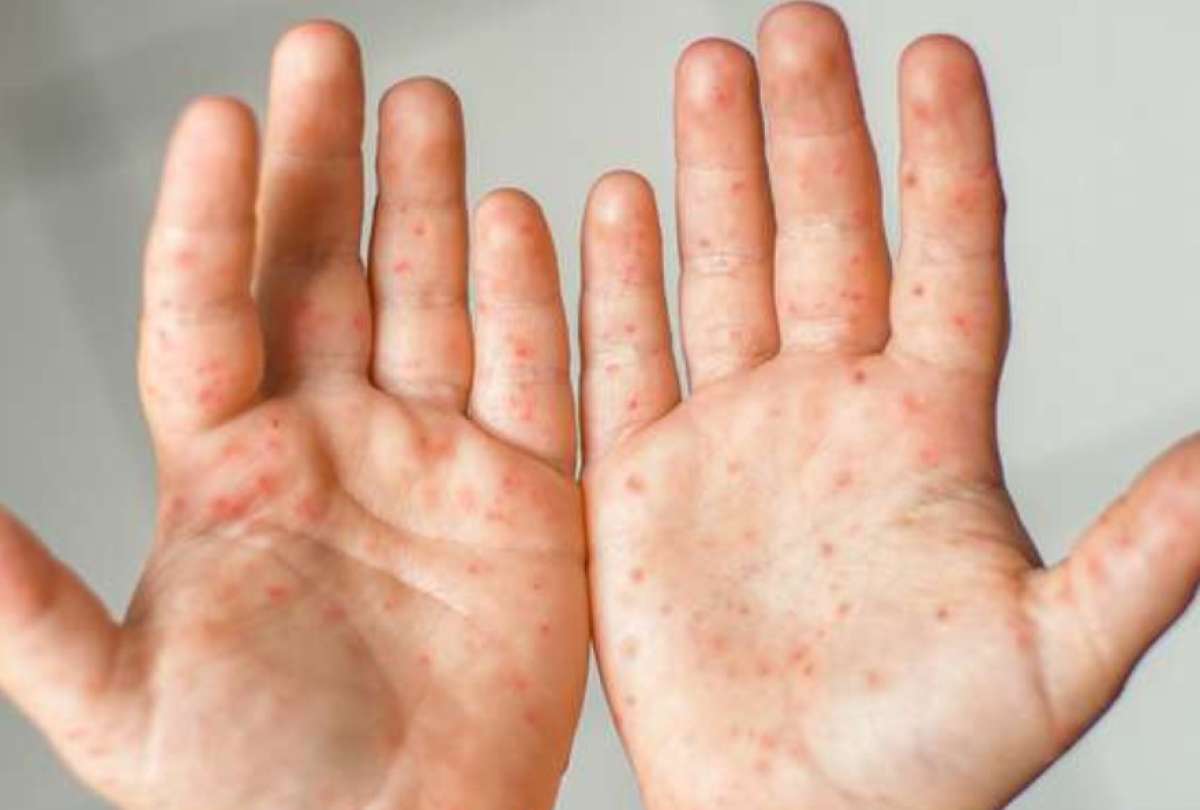 Virus de manos, pies y boca ¿Cuáles son los síntomas y cómo tratarlo?