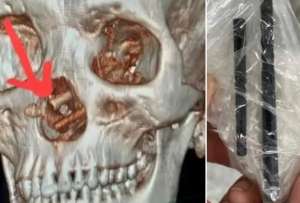 Extraen dos palillos de la nariz de un hombre en Vietnam