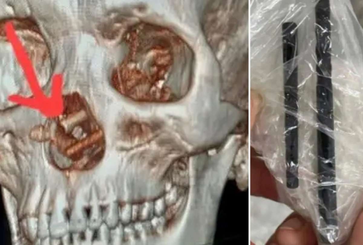 Extraen dos palillos de la nariz de un hombre en Vietnam
