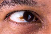¿Cómo prevenir el cáncer de ojo?
