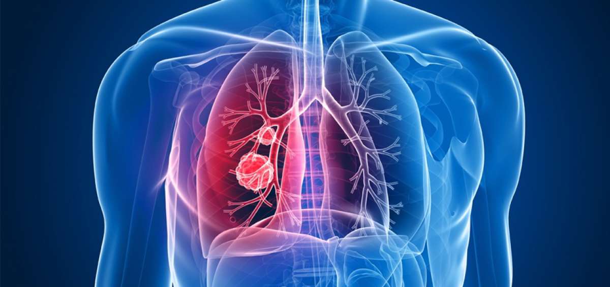 El diagn&oacute;stico tard&iacute;o complica la fibrosis qu&iacute;stica