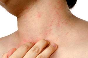 Psoriasis, una enfermedad por descifrar