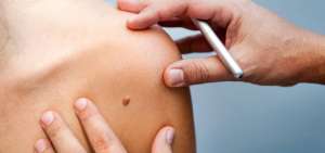 Uno de cada tres personas con c&aacute;ncer sufre un tipo de enfermedad maligna en la piel, seg&uacute;n los datos de la Organizaci&oacute;n Mundial de la Salud. Australia tiene la mayor incidencia de melanomas del mundo.