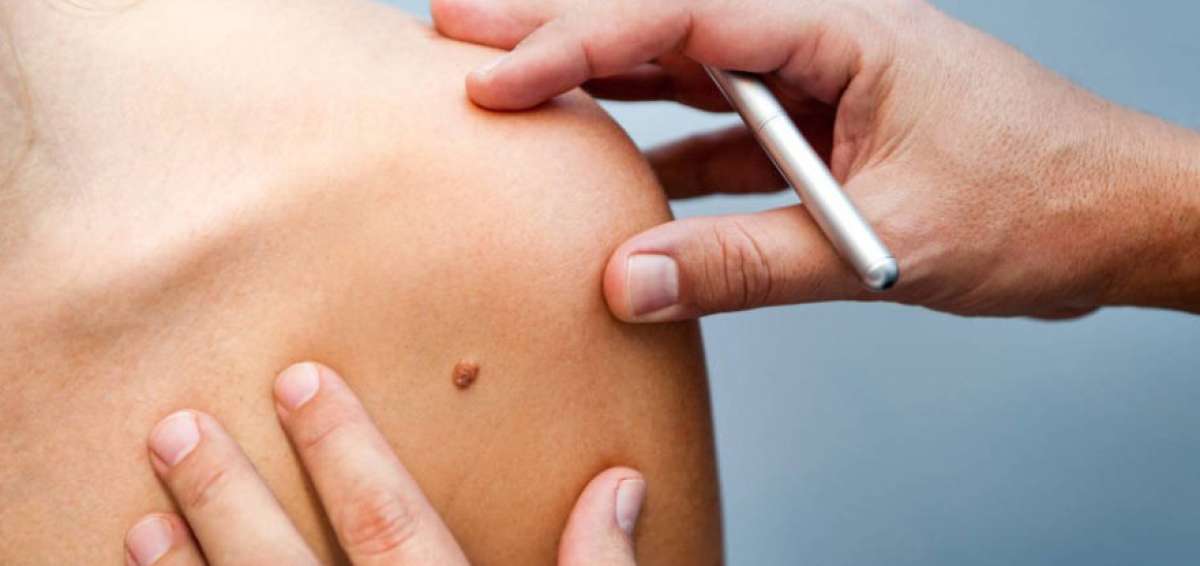 Uno de cada tres personas con c&aacute;ncer sufre un tipo de enfermedad maligna en la piel, seg&uacute;n los datos de la Organizaci&oacute;n Mundial de la Salud. Australia tiene la mayor incidencia de melanomas del mundo.