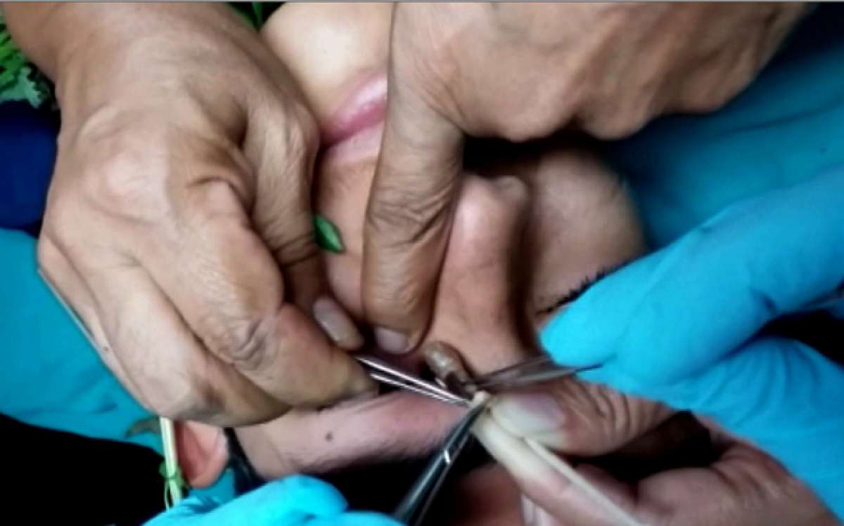 Se determin&oacute; que la hinchaz&oacute;n era provocada por una larva gigante que estaba instalada en el ojo del paciente. Foto: AFP
