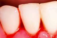 El sangrado de las encías podría ser una señal de la enfermedad periodontal