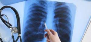 El c&aacute;ncer de pulm&oacute;n no se lo diagnostica a tiempo en Latinoam&eacute;rica.