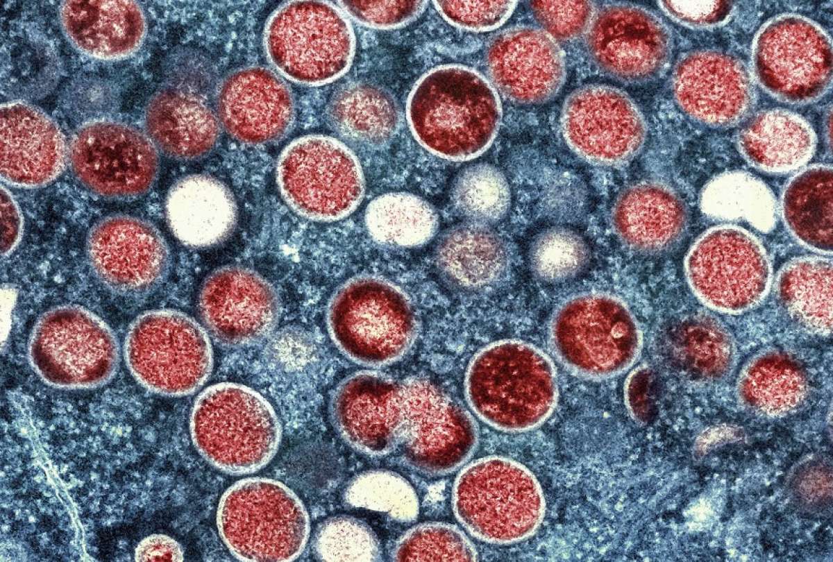 La viruela del mono causa estragos en Estados Unidos por el incremento de contagios.
