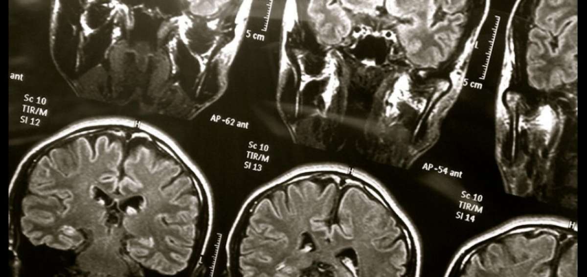 Conmociones cerebrales en atletas j&oacute;venes se diagnosticar&iacute;an a tiempo
