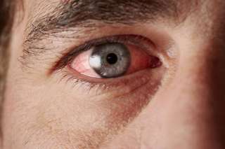Causas y tratamientos del ojo rojo en las festividades de Año Nuevo