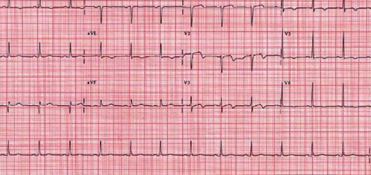 &iquest;Qu&eacute; es el edema pulmonar agudo, la causa de la muerte de Fausto Cayambe?