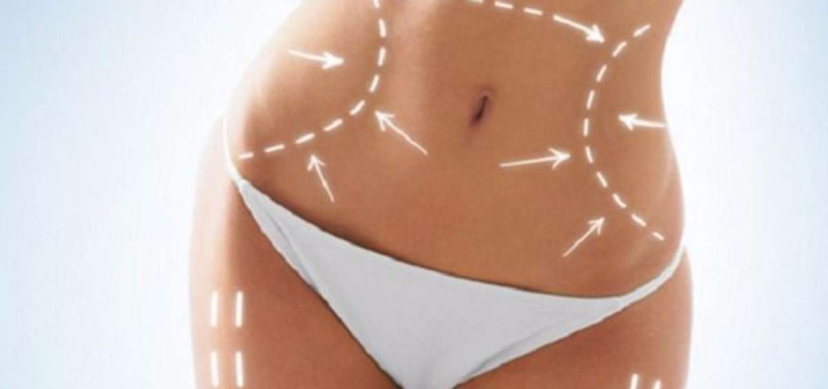 El 70% de los pacientes opta por hacerse la lipoescultura