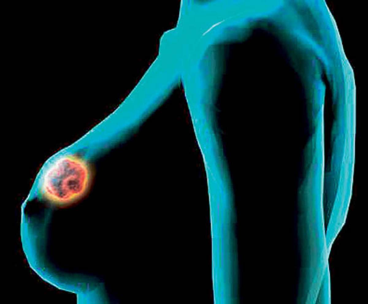 Se descubri&oacute; que al inhibir la prote&iacute;na R-ras 2 es posible detener el tumor de mamas. 