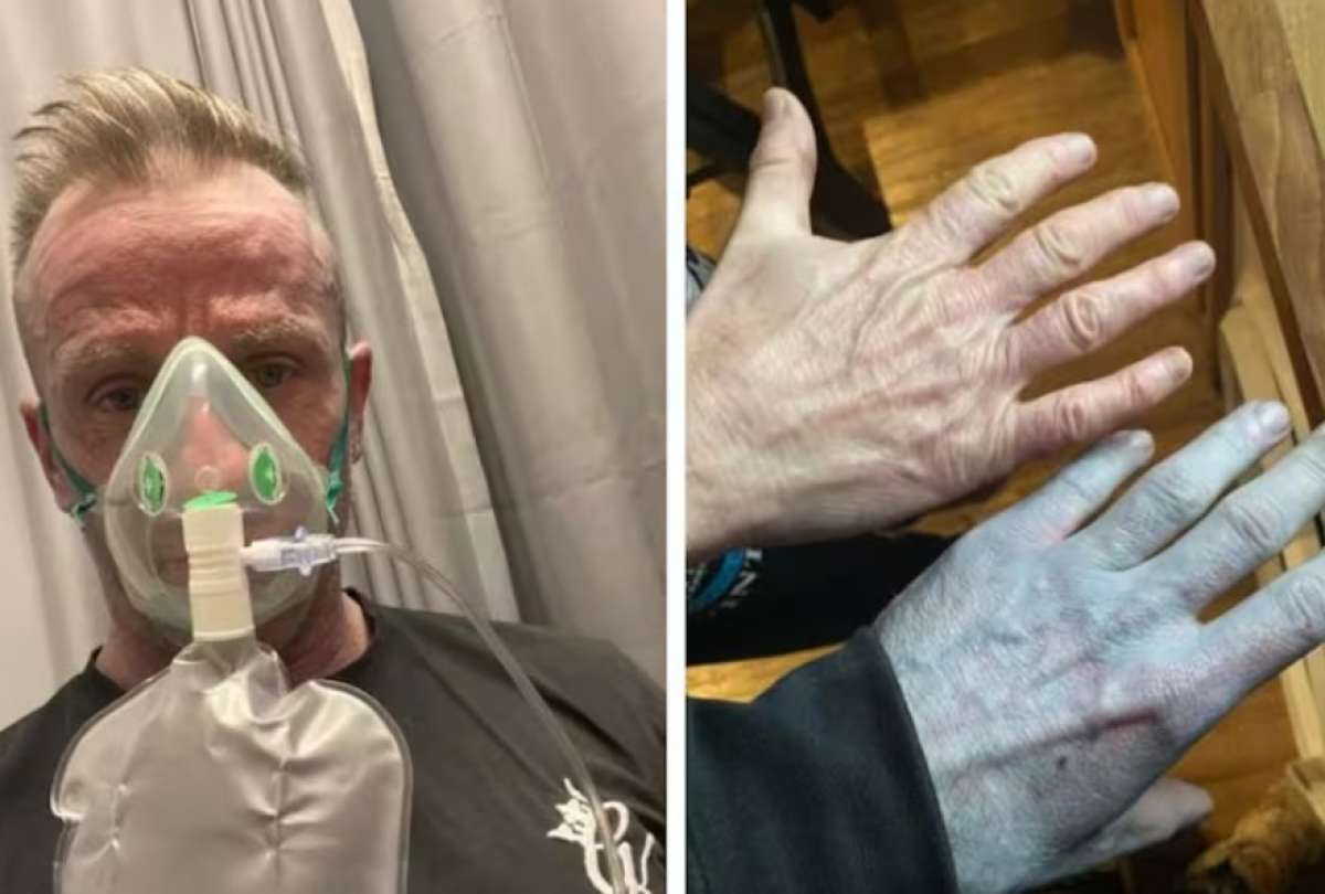 La piel de Tommy Lynch se tornaba azul y esto fue lo que ocurri&oacute;. 